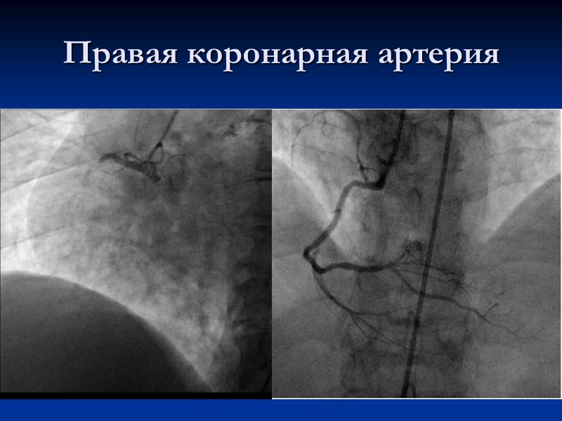Правая коронарная артерия